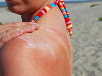 Британски експерти дават съвети за справяне със слънчевите изгаряния